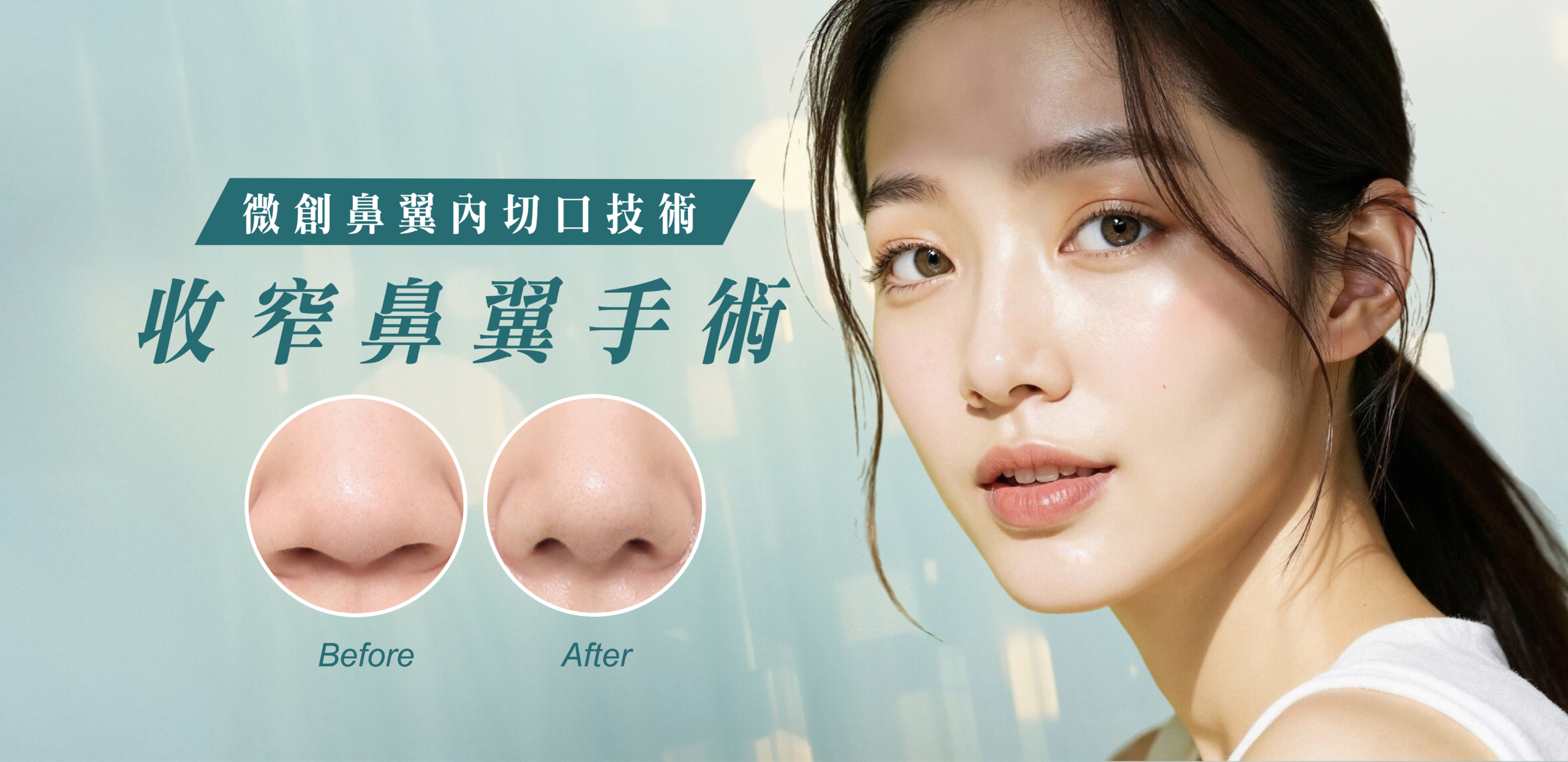 收窄鼻翼手術