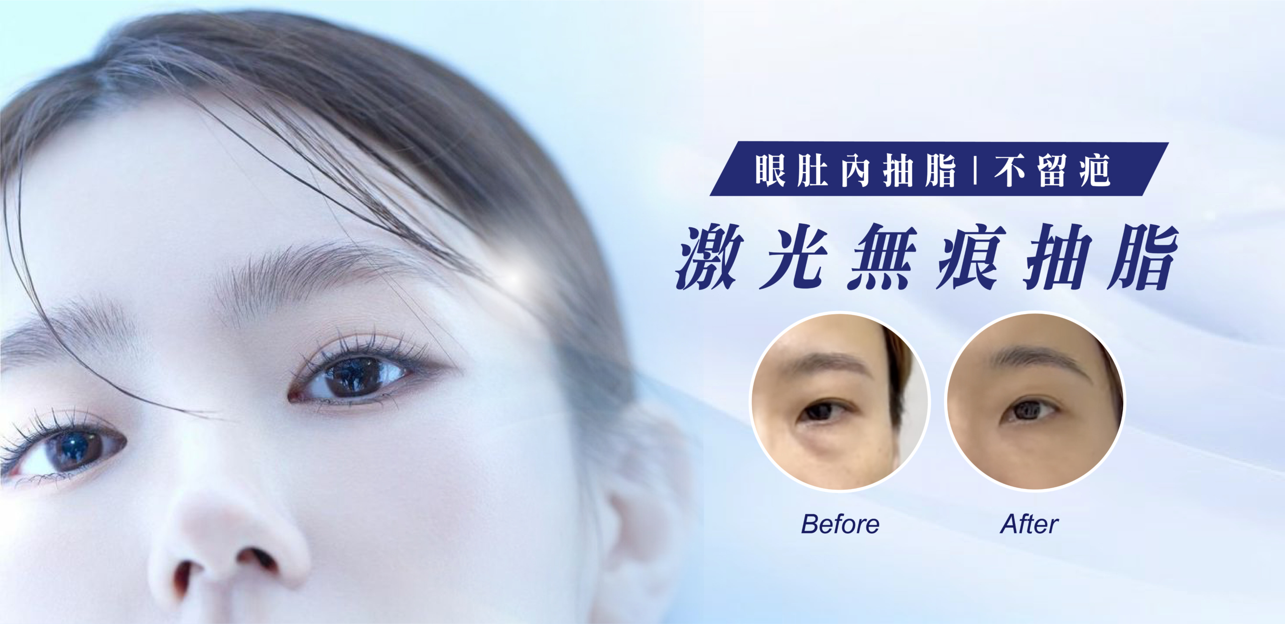 激光無痕抽脂 激光無痕抽脂
