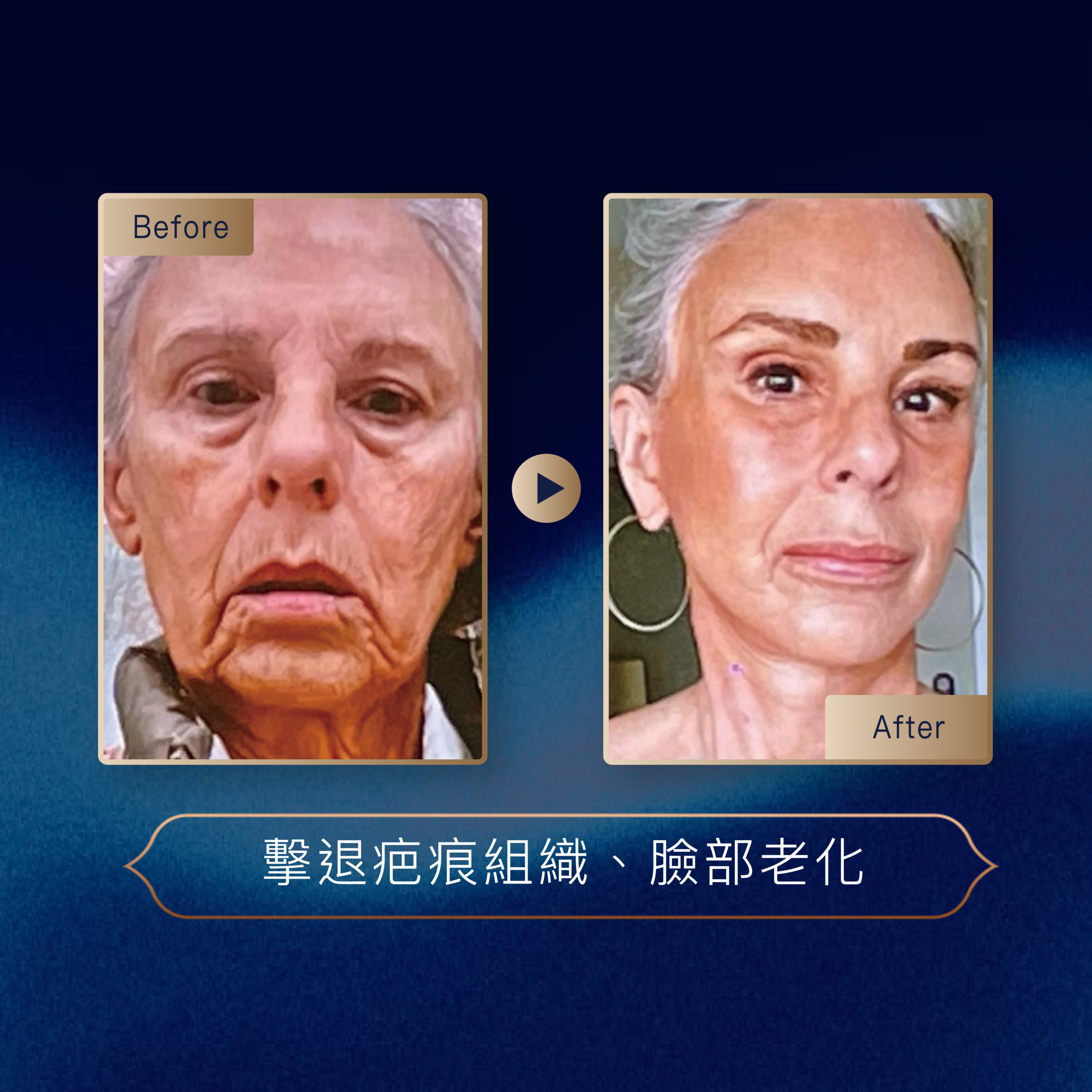 <img src='sylfirm-treatment.jpg' alt='SylfirmX 黃金微針療程示意圖'>
