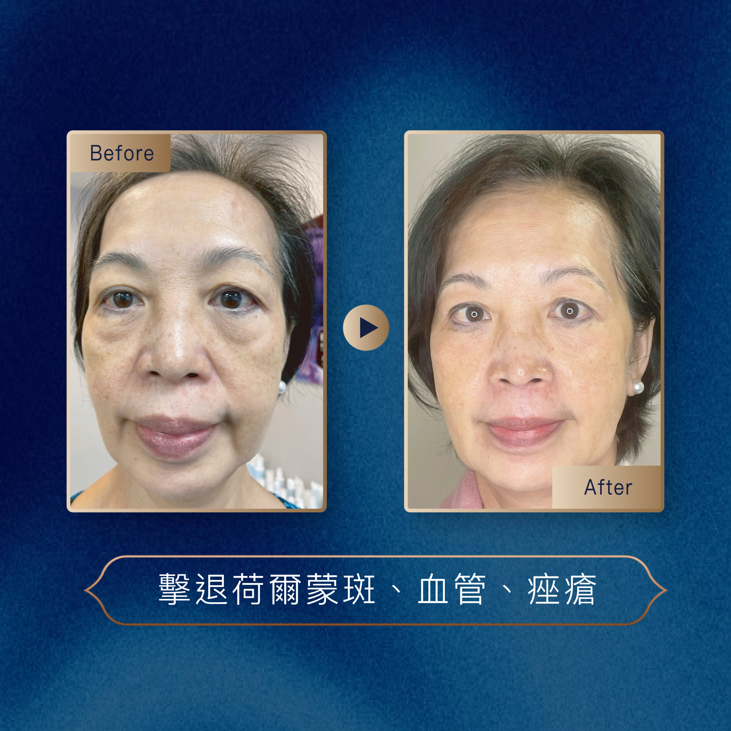 <img src='sylfirm-treatment.jpg' alt='SylfirmX 黃金微針療程示意圖'>

