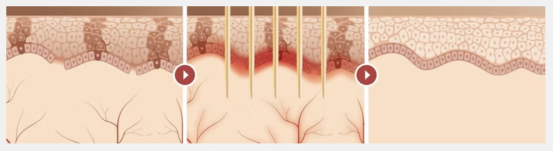 <img src='sylfirm-treatment.jpg' alt='SylfirmX 黃金微針療程示意圖'>
